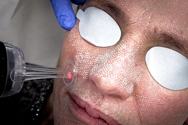 Dermatología láser