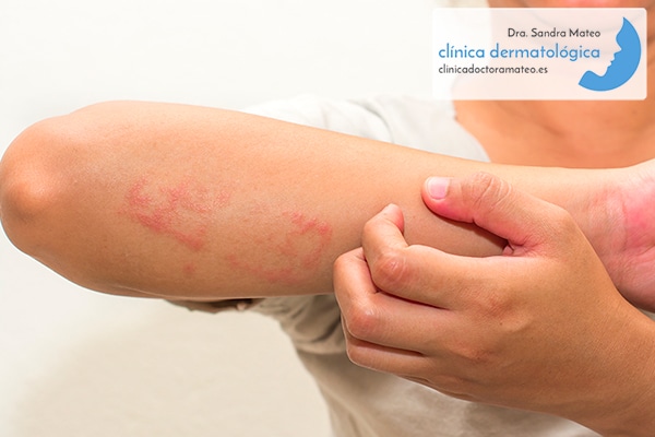 Valle No pretencioso Apariencia Dermatitis atópica: Tratamiento » Dra. Sandra Mateo